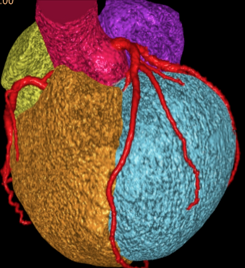 CT Coronary Angiography